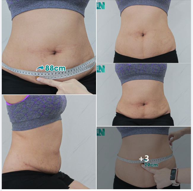 HÚT MỠ TẠO DÁNG THẨM MỸ CHO CHỊ KH VIỆT KIỀU MỸ (8X) THỰC HIỆN COMBO: BỤNG, TAY, LƯNG VÀ NÁCH. ĐÃ CÓ CHỊ GÁI THỰC HIỆN GIẢM MỠ TẠI EKIP. TRỰC TIẾP 15H00 HÔM NAY