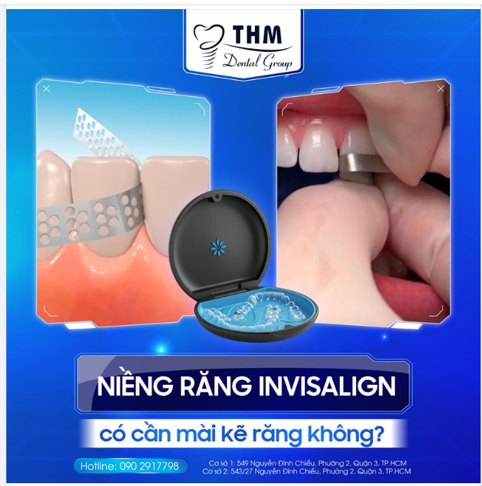 NIỀNG RĂNG INVISALIGN CÓ CẦN MÀI KẼ RĂNG KHÔNG