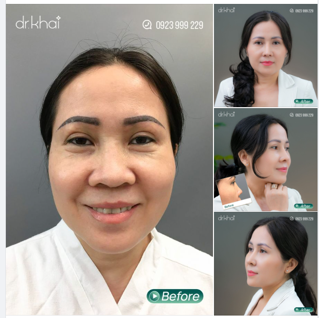 HÃY LUÔN XINH ĐẸP DÙ Ở BẤT KỲ ĐỘ TUỔI NÀO CHÚC MỪNG KHÁCH HÀNG VỚI DÁNG MŨI MỚI THẬT ĐẸP