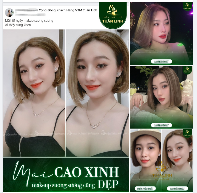 Feedback siêu có tâm từ khách hàng nâng mũi cấu trúc tại Tuấn Linh!!
