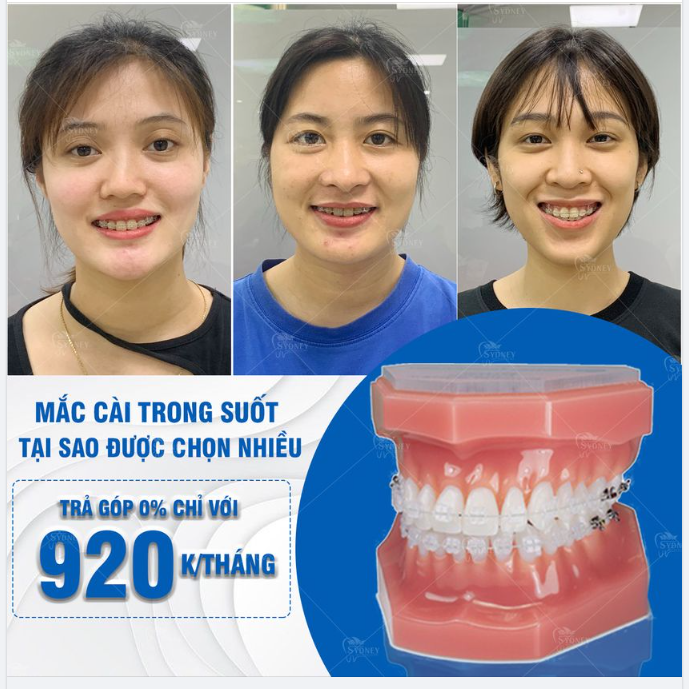 TẠI SAO MẮC CÀI TRONG SUỐT LUÔN ĐƯỢC CHỊ EM LỰA CHỌN NHIỀU KHI NIỀNG RĂNG?