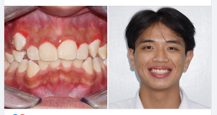 Một ca niềng mắc cài kim loại tự buộc của bác sĩ Huyền, chi nhánh Phú Nhuận