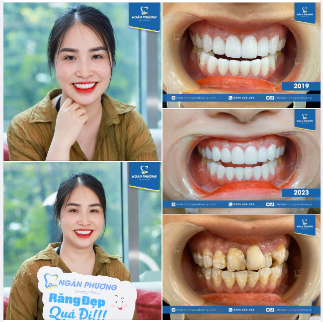 “Ăn hải sản, tất cả mọi thứ đều bình thường. Chiều hôm lắp răng về, hôm đấy về ăn chân gà luôn, ăn tất cả mọi thứ, không có vấn đề gì hết.”