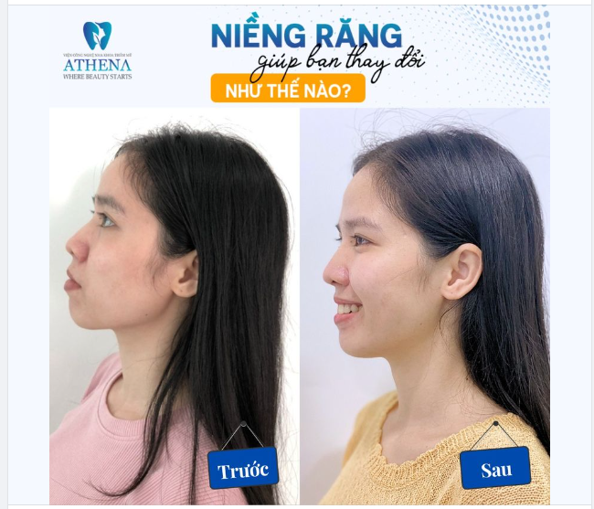 NIỀNG RĂNG LÃI ĐƯỢC SỐNG MŨI VÀ GÓC NGHIÊNG CHỈ SAU 1 NĂM!