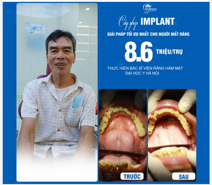 LỢI ÍCH CỦA CẤY GHÉP RĂNG IMPLANT