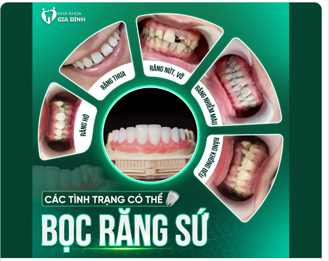 TRƯỜNG HỢP NÀO THÌ CÓ THỂ THẨM MỸ RĂNG SỨ?