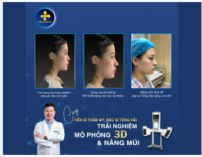 DÁNG MŨI MÔ PHỎNG 3D & THỰC TẾ BÁC SĨ NÂNG CÓ KHÁC NHAU KHÔNG???