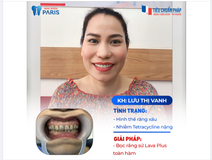 Cái răng cái tóc, là góc con người. Thay đổi hàm răng là thay đổi luôn cả "giao diện" đó, mọi người biết chưa?