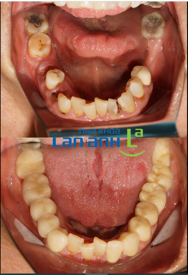 Một ca phục hình cầu răng sứ của bác sĩ Hoài, chi nhánh 149 Tôn Dật Tiên, Q.7!