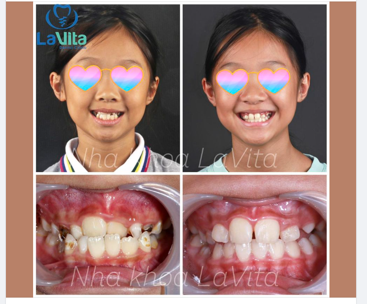 Khớp cắn ngược là một trong những trường hợp bất thường của răng, gây ảnh hưởng nghiêm trọng đến sức khoẻ và thẩm mỹ của người bệnh.