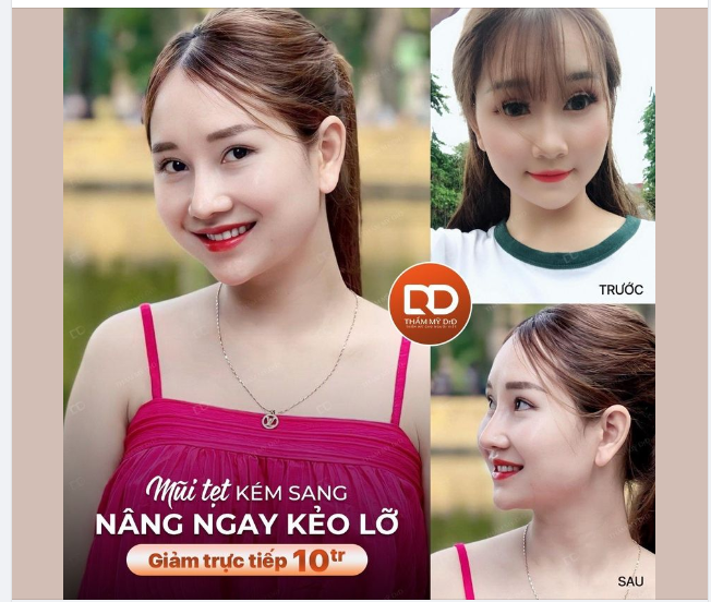 GIÁ CỰC TỐT CHO SIÊU CÔNG NGHỆ NÂNG MŨI PERFECT DFORM