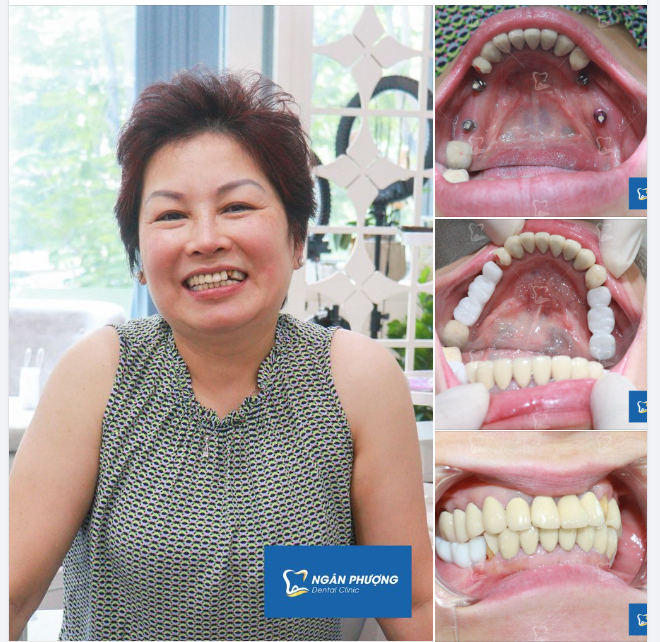 Mất răng muốn bắc cầu kiều. Trồng trụ chắc khỏe gấp nhiều yên tâm