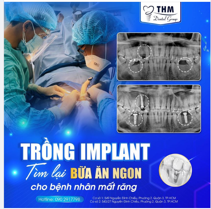 TRỒNG RĂNG IMPLANT - THOẢI MÁI ĂN NHAI, BỀN CHẮC TRỌN ĐỜI