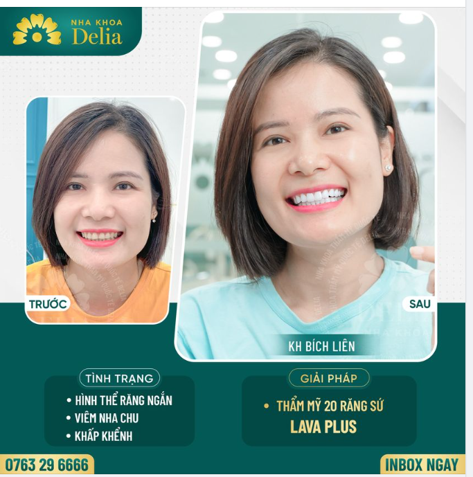 Chị Bích Liên đến với nha khoa Delia