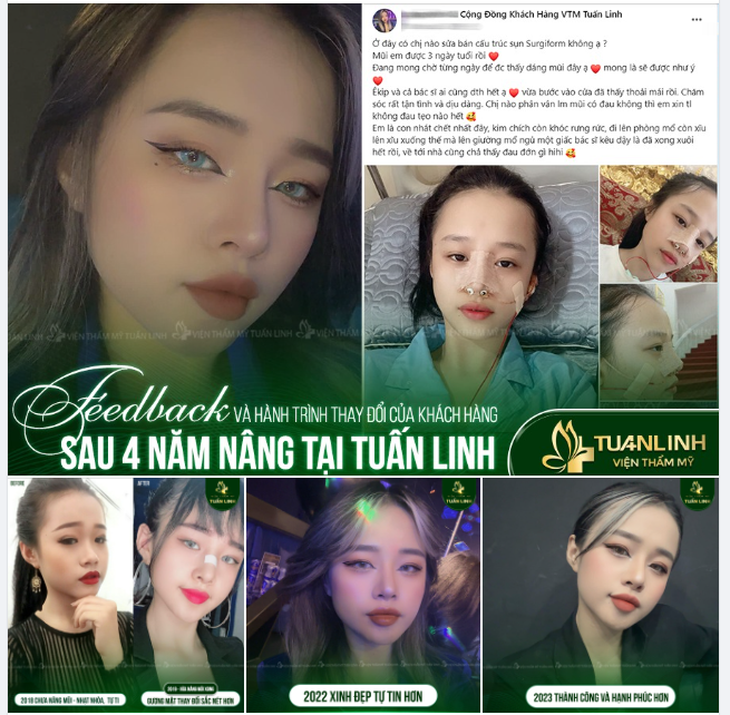 Feedback và hành trình thay đổi của cô nàng 9x sau 4 năm nâng mũi tại Tuấn Linh - CỰC ẤN TƯỢNG!!