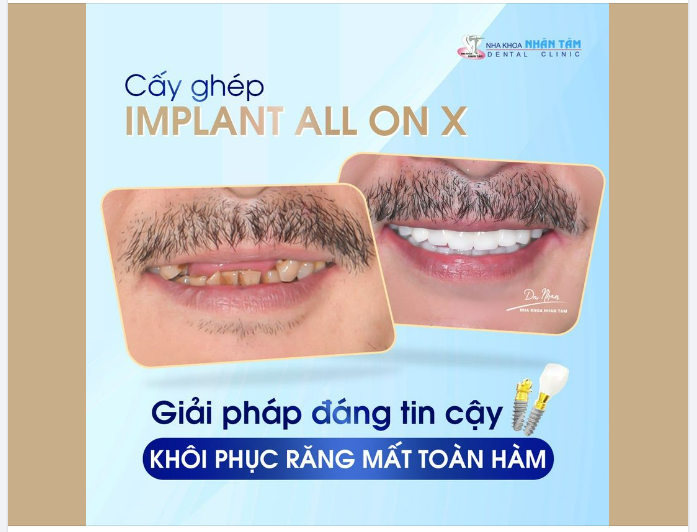 KHÁM PHÁ SỰ THAY ĐỔI VƯỢT BẬC KHI TRỒNG RĂNG IMPLANT TOÀN HÀM