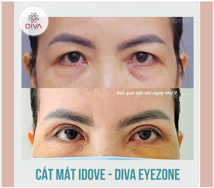 KẾT QUẢ SAU CẮT MÍ MẮT IDOVE: 2 MÍ ĐỀU ĐẸP, CÂN ĐỐI