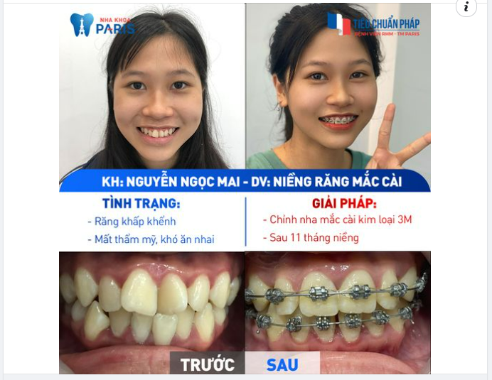 18 Tuổi Niềng Răng, Con Tự Tin Tỏa Sáng