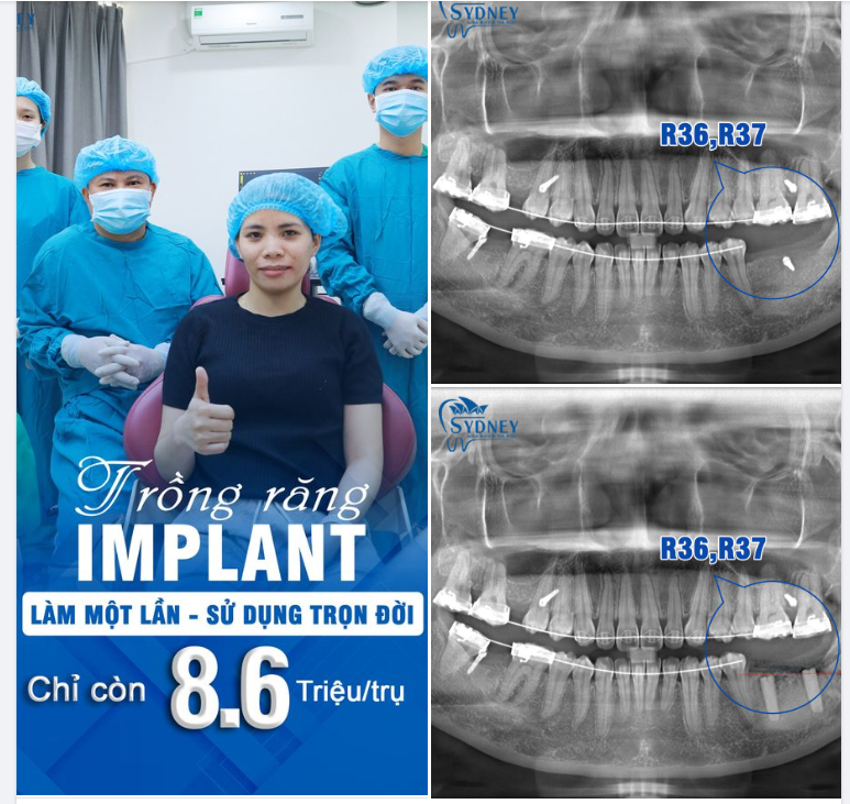 CẤY GHÉP IMPLANT KHÔI PHỤC RĂNG ĐÃ MẤT