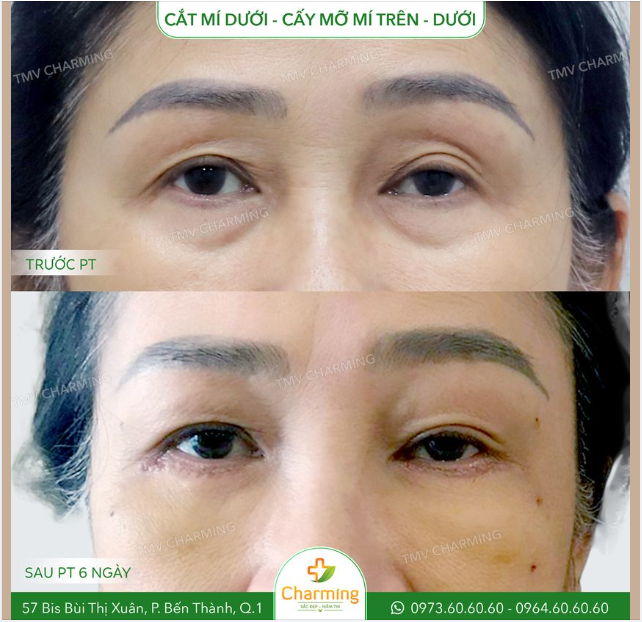 Một trường hợp rất chi khổ tâm. Đó là khi mí dưới của bạn thừa mỡ nhưng mí trên lại thiếu mà lại không có phẫu thuật nào có thể lấy mỡ mí dưới đắp lên mí trên được .-.