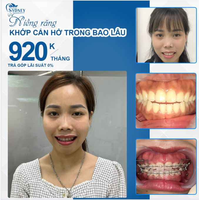 Niềng răng khớp cắn hở trong bao lâu?