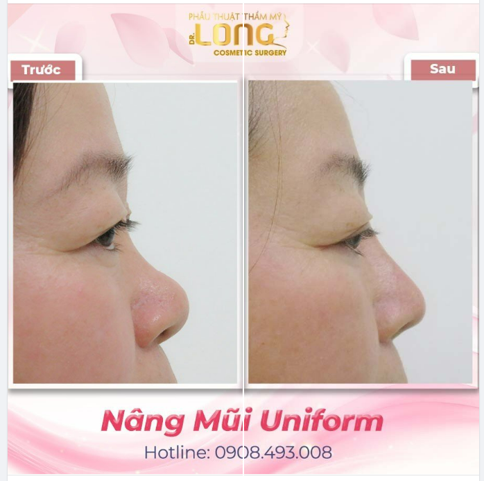 NÂNG MŨI - DỊCH VỤ CÀNG CAO MỨC GIÁ CÀNG GIẢM