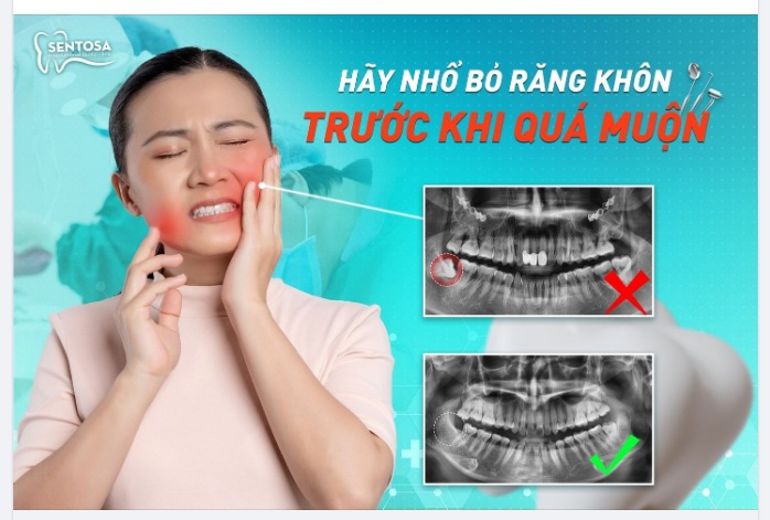 HÃY NHỔ BỎ RĂNG KHÔN TRƯỚC KHI QUÁ MUỘN