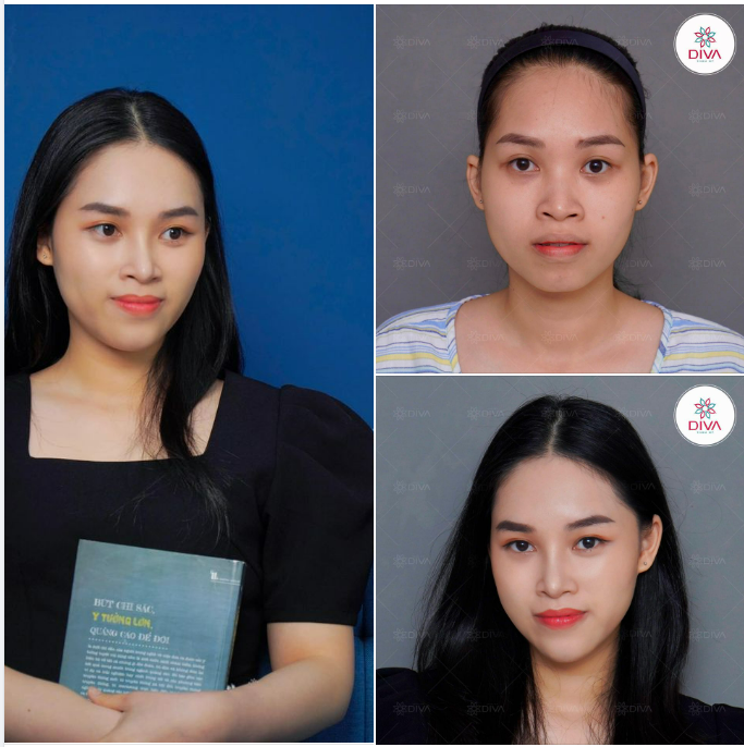 KẾT QUẢ SAU NÂNG MŨI, TIÊM MỠ COLEMAN MẶT NHƯ THẾ NÀO?