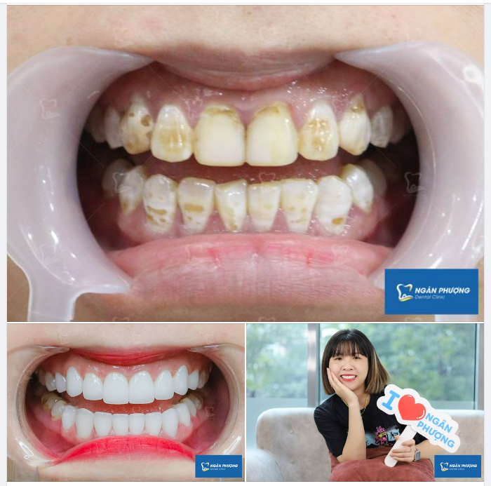 Thiểu sản men răng nhìn bề ngoài có vẻ chỉ mất thẩm mỹ nhưng người trong cuộc mới hiểu chuyện trong kẹt