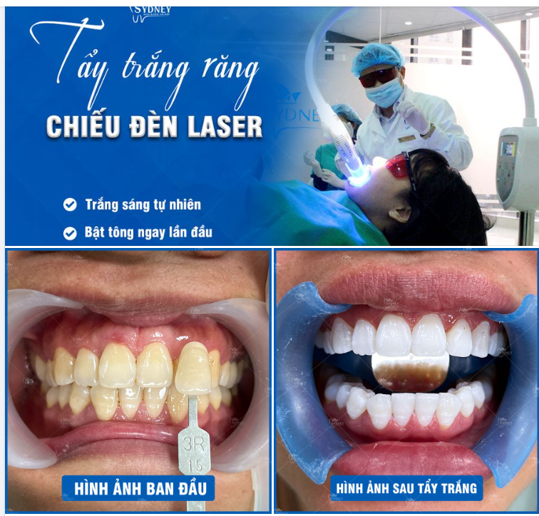 TẨY TRẮNG RĂNG - BẬT TÔNG NGAY LẦN ĐẦU TẨY
