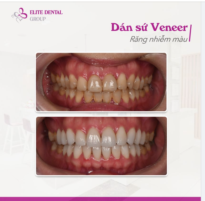 Khắc phục răng nhiễm màu với mặt dán sứ Veneer