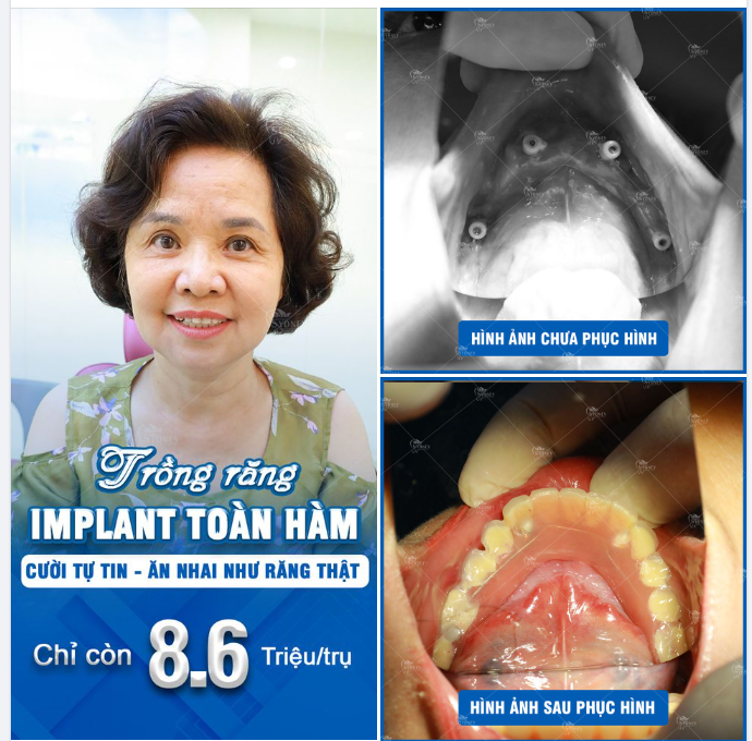 Ưu điểm vượt trội của cấy ghép Implant toàn hàm