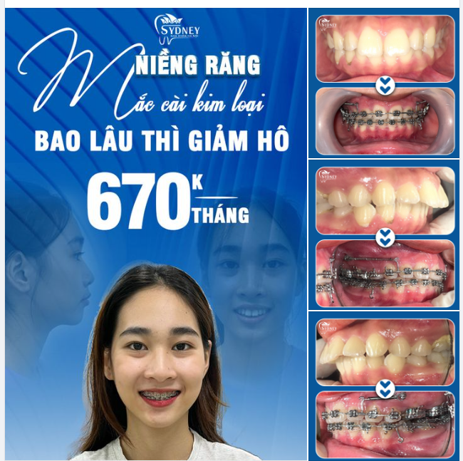 NIỀNG RĂNG BAO LÂU HẾT HÔ?