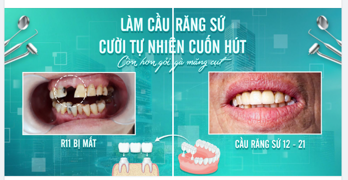 GÓC FEEDBACK  LÀM CẦU RĂNG SỨ CƯỜI TỰ NHIÊN CUỐN HÚT CÒN HƠN GỎI GÀ MĂNG CỤT