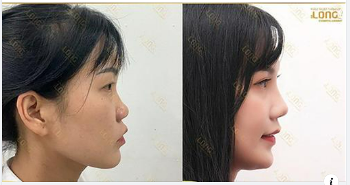 ĐẦU TƯ LÀM ĐẸP NÂNG MŨI nhưng không biết điều này mũi khó mà đẹp