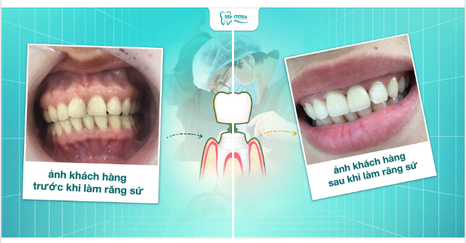 GÓC FEEDBACK  RĂNG SỨ CHẤT LƯỢNG Y NHƯ RĂNG THẬT