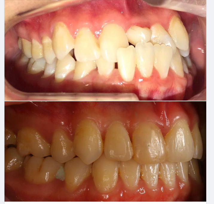 Một ca niềng mắc cài kim loại tự buộc tại chi nhánh 61 Nguyễn Cơ Thạch, Sala, Q2