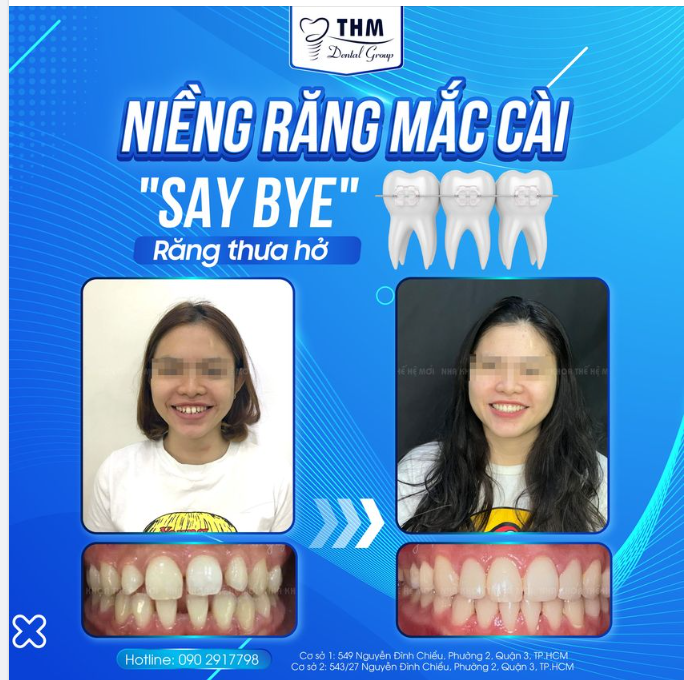 NIỀNG RĂNG MẮC CÀI - "SAY BYE" RĂNG THƯA HỞ