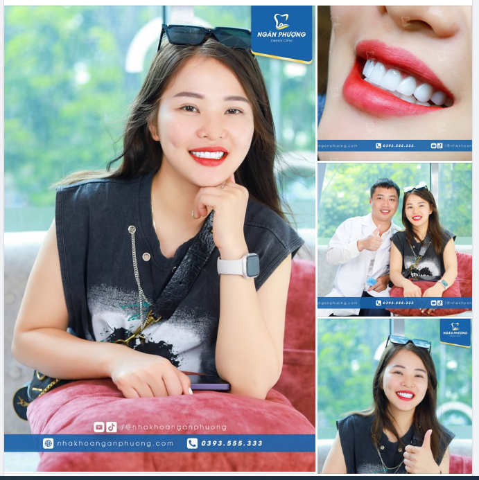 Cười xinh có lúm đồng tiền  Thêm răng sáng đẹp tự tin rạng ngời