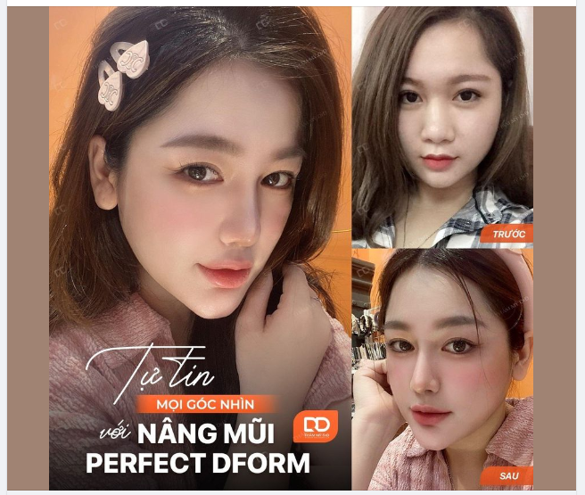Tự tin mọi góc nhìn với Nâng mũi Perfect Dform