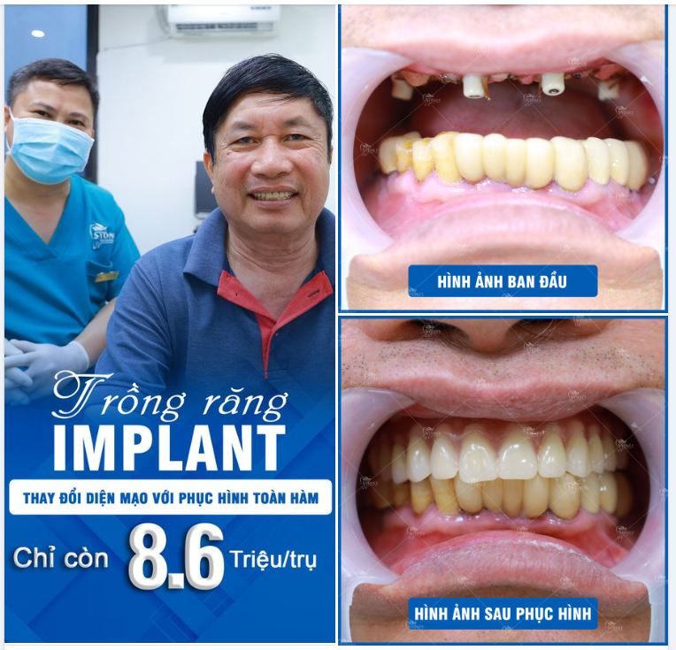 ĂN NHAI KHÓ ĐÃ CÓ IMPLANT TOÀN HÀM