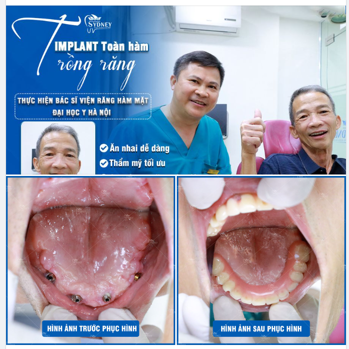 TRỒNG RĂNG IMPLANT - MÓN QUÀ BÁO HIẾU TRỌN TÌNH THÂN