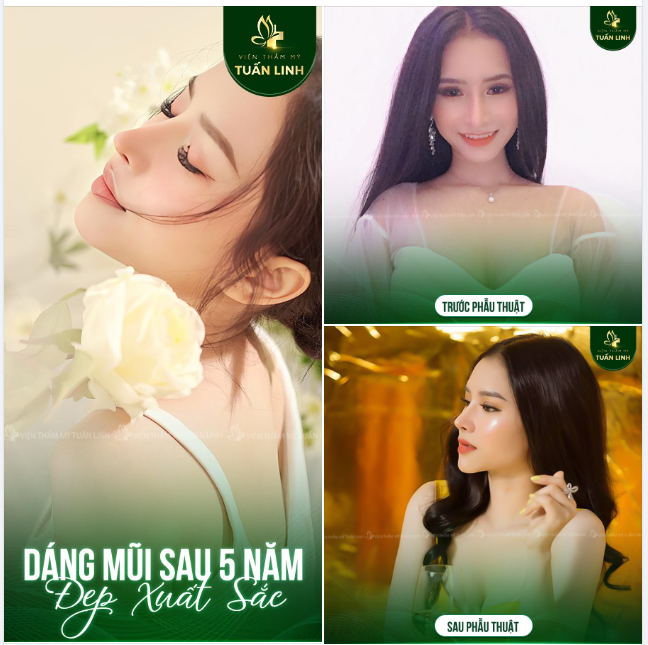 Một trong những lí do khách hàng lựa chọn nâng mũi tại Tuấn Linh đó là: Ekip bác sĩ cực kỳ mát tay, làm rất có tâm, nâng mũi xong gần như là đẹp lâu dài luôn mà không cần phải chỉnh sửa, thay đổi dáng hay làm lại đó ạ.
