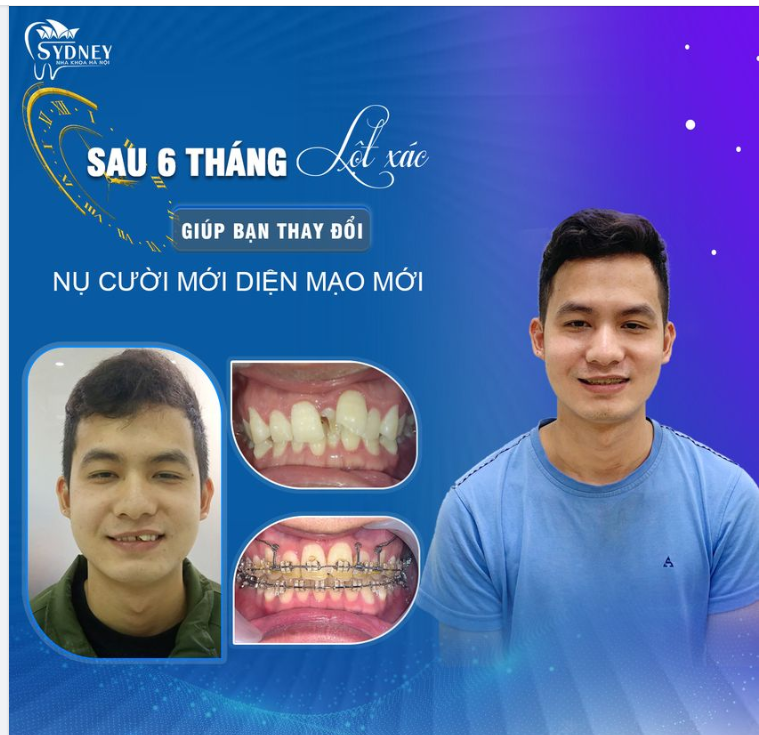 THAY ĐỔI “DIỆN MẠO MỚI” SAU 6 THÁNG NIỀNG RĂNG