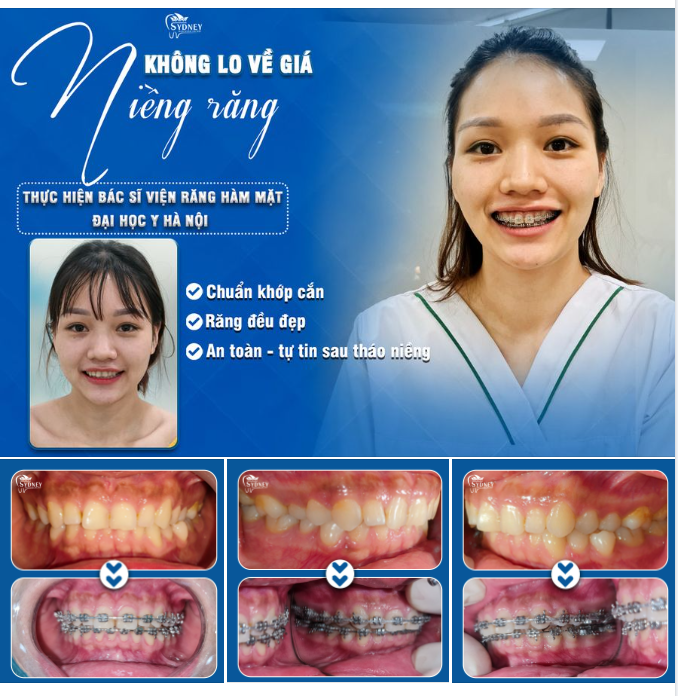 NIỀNG RĂNG TRONG HÈ - KHÔNG LO VỀ GIÁ