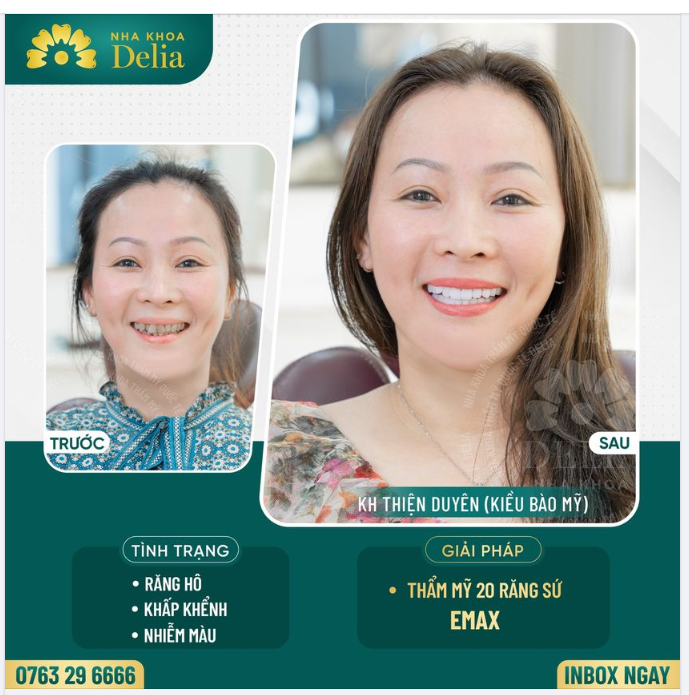 Thẩm mỹ răng sứ khắc phục răng nhiều khuyết điểm - kiều bào Mỹ tự tin khoe nụ cười đều đẹp rạng rỡ