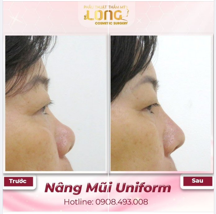 CÔ KHÁCH SAU KHI NÂNG MŨI CỨU RỖI CẢ KHUÔN MẶT