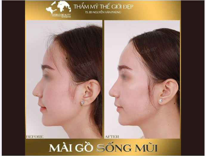 Chỉ với phẫu thuật mài gồ có ngay mũi đẹp sắc nét, thon gọn