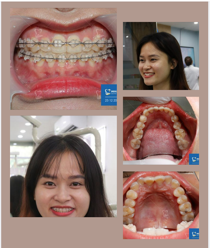 Khớp cắn ngược không chỉ khiến hoạt động của răng cửa không được linh hoạt còn gây mất thẩm mỹ trên khuôn mặt.
