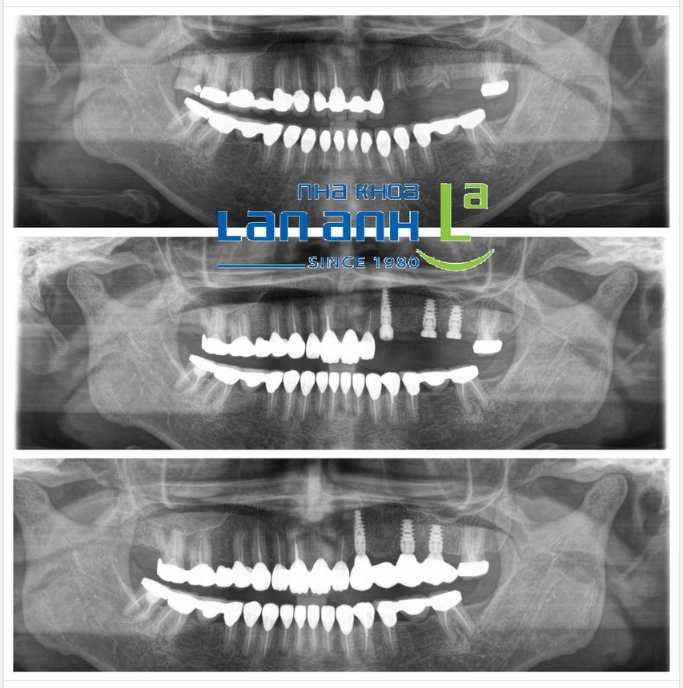 Một ca đặt implant phục hình lại răng mất của BS Vũ tại chi nhánh Sala, Thủ Đức.